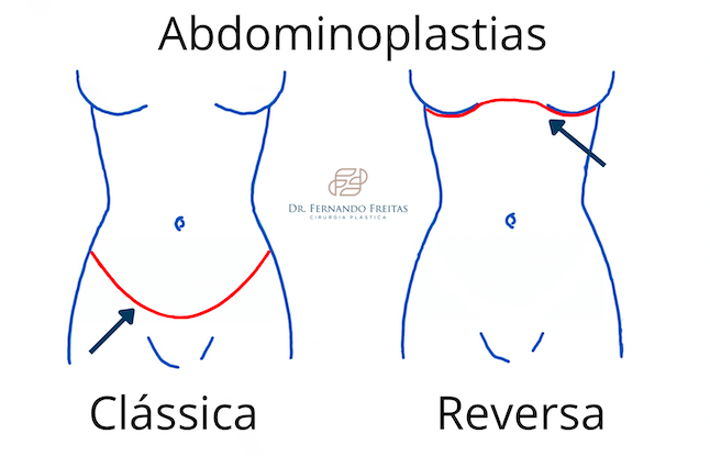 abdominoplastia-reversa