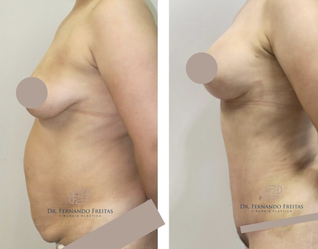 Antes e depois da correção de diástase e flacidez abdominal