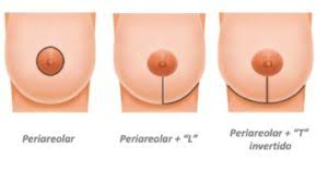 figura mostrando os tipos de cicatriz de mamoplastia redutora