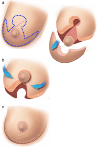 Desenho esquemático de como é feita a mamoplastia redutora