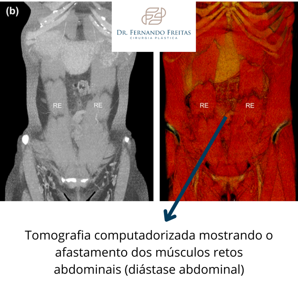 tomografia mostrando diástase abdominal